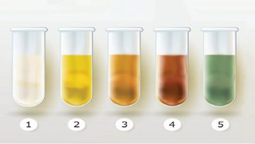 5 màu sắc của nước tiểu cho chúng ta biết về tình trạng sức khoẻ7