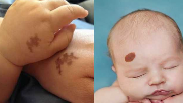 Vết bớt của kiếp này có thể là những vết thương từ kiếp trước. Nguồn ảnh: thoidaitamlinh.top